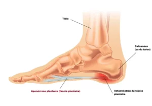 schéma du fasciia plantaire ou aponévrosite plantaire