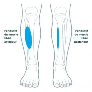 schéma de la périostite tibiale