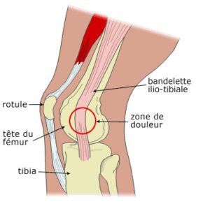 schéma du syndrome essuie glace ou TFL