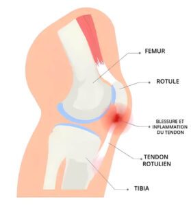 tendinite rotulienne schema