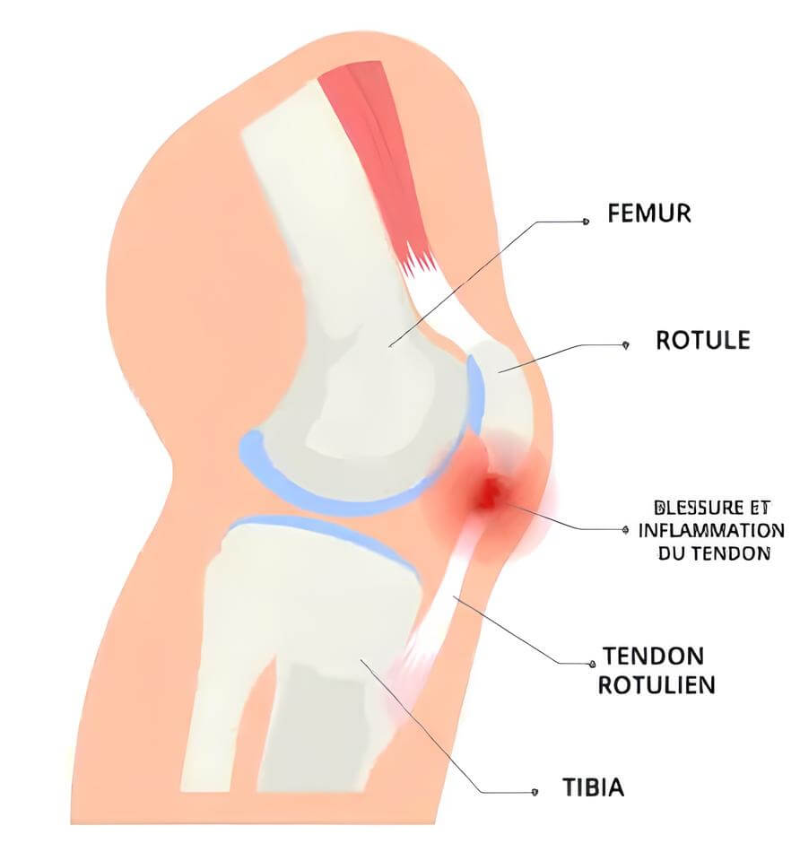 schéma tendinite rotulienne