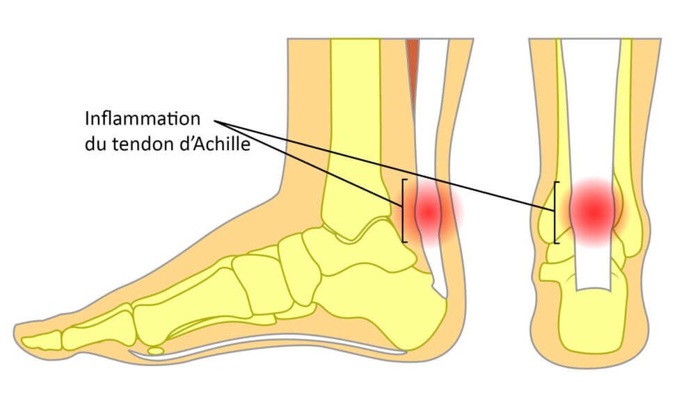 schéma tendinite tendon d'Achille