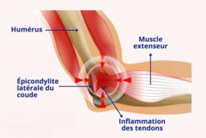 schéma tendinite coude