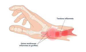 shcema tendinite poignet